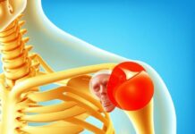 Когда плечо «выпадает»: понятный гид по вывиху плечевого сустава Когда плечо «выпадает»: понятный гид по вывиху плечевого сустава