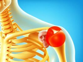 Когда плечо «выпадает»: понятный гид по вывиху плечевого сустава