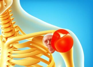 Когда плечо «выпадает»: понятный гид по вывиху плечевого сустава